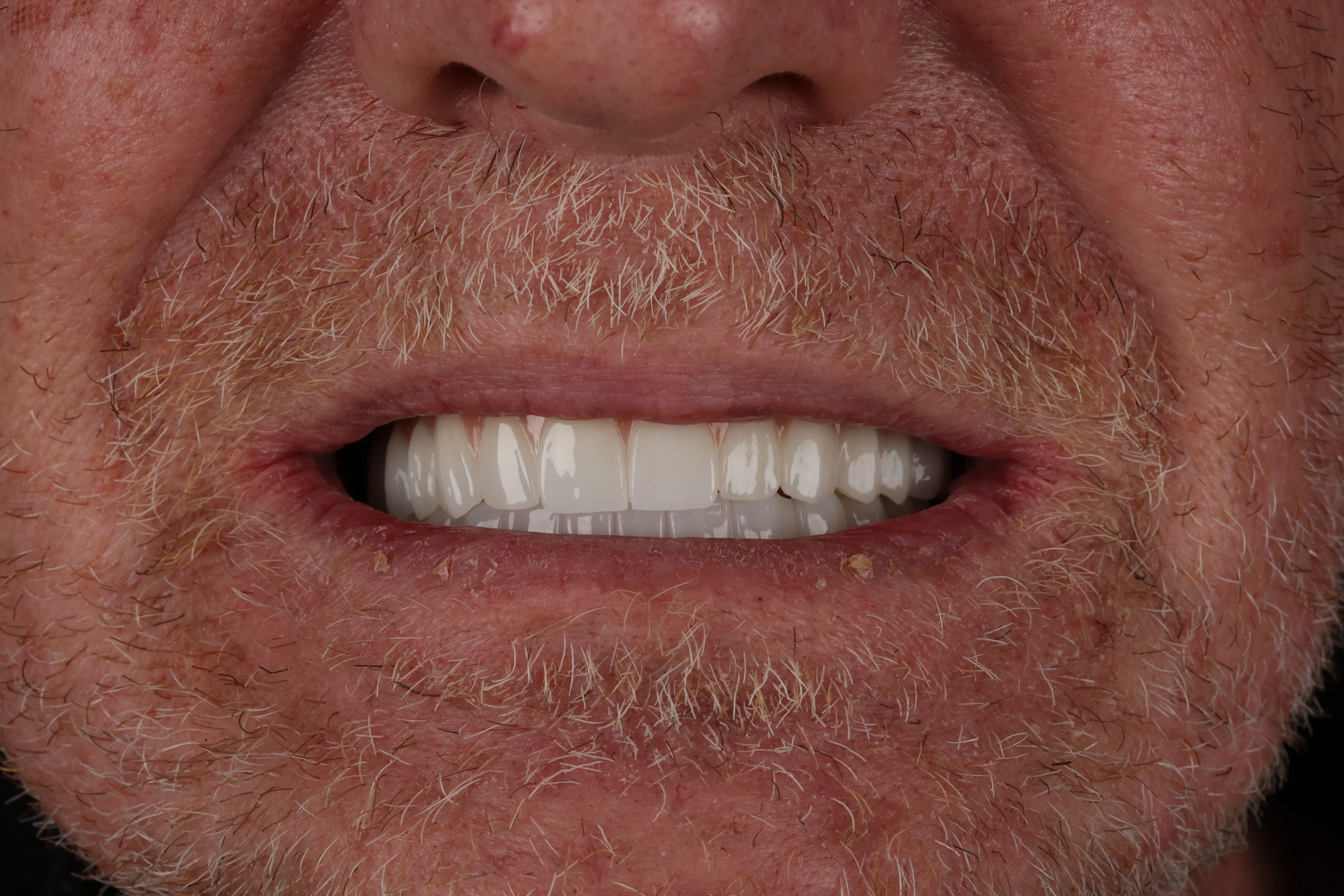 Dental treatment before and after, patient result 2 — After