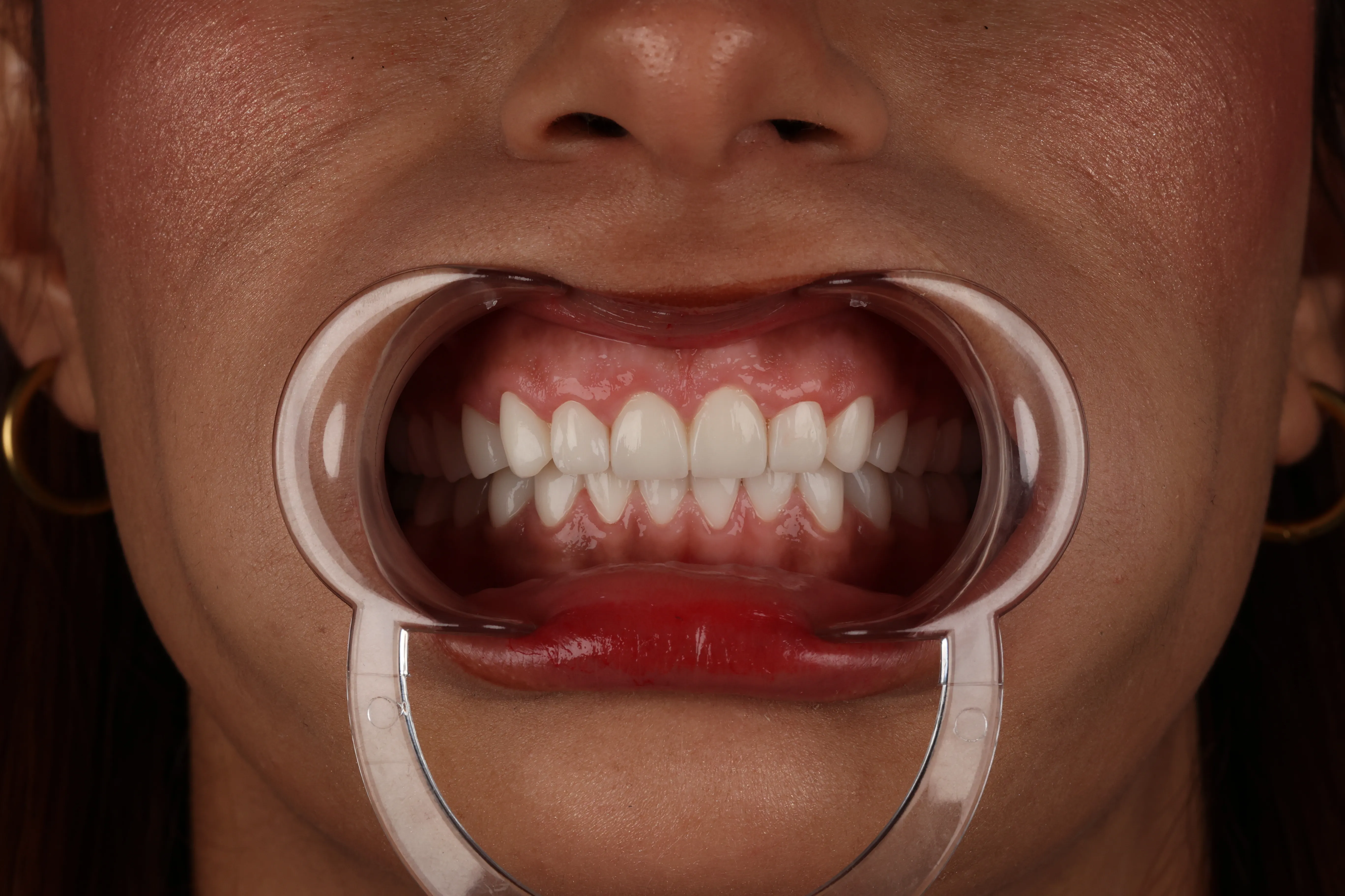 Dental treatment before and after, patient result 3 — After