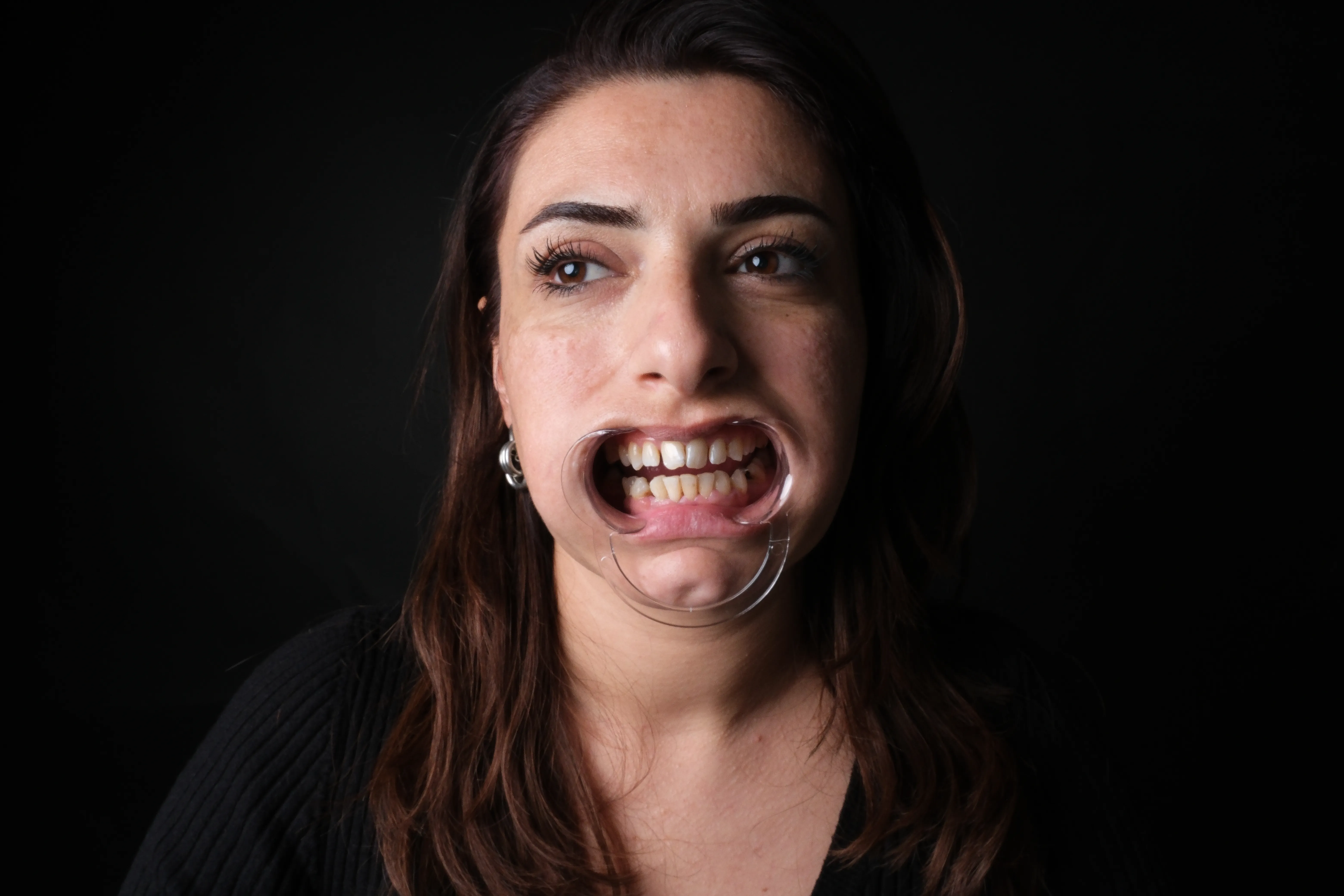 Dental treatment before and after, patient result 1 — Before