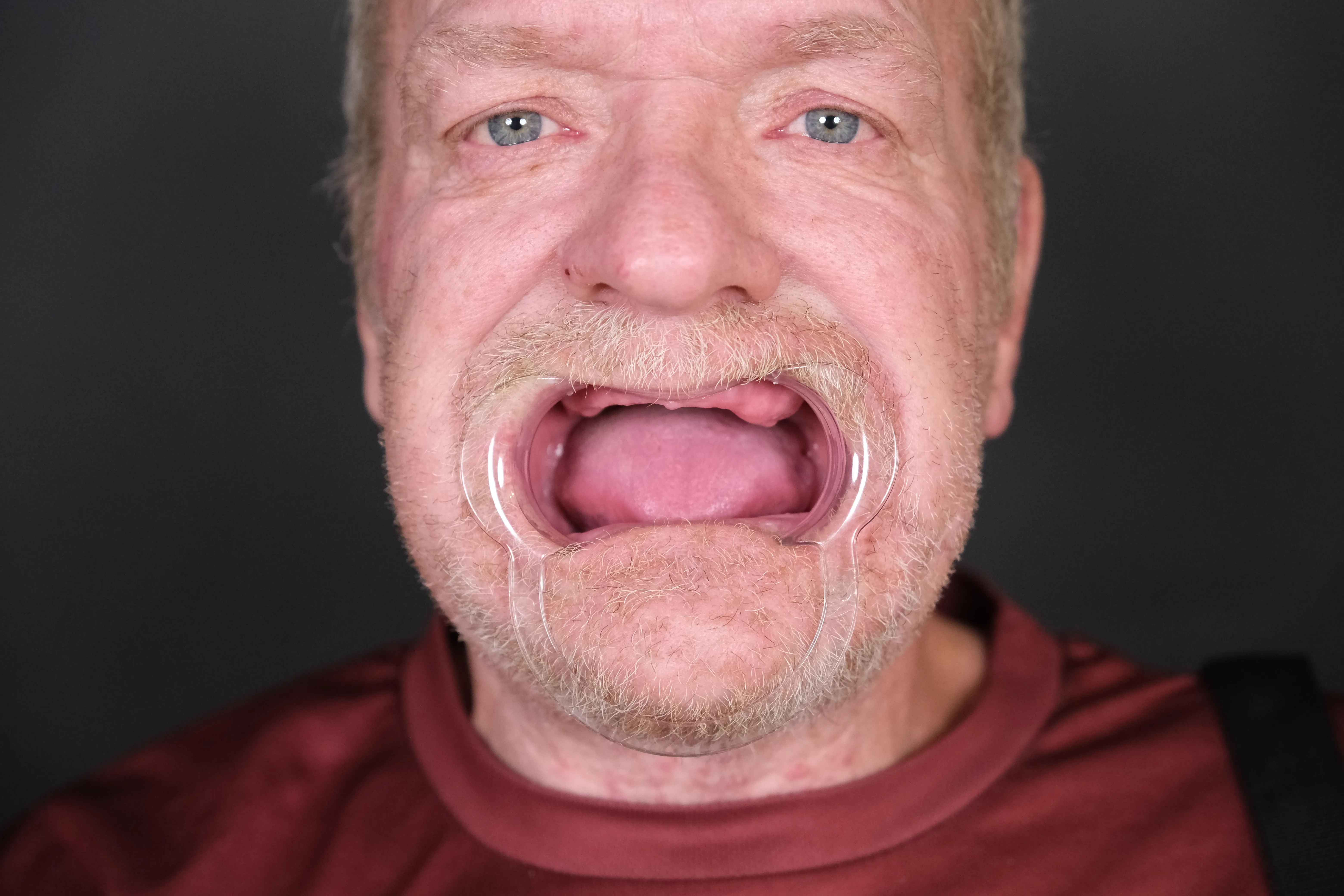 Dental treatment before and after, patient result 2 — Before