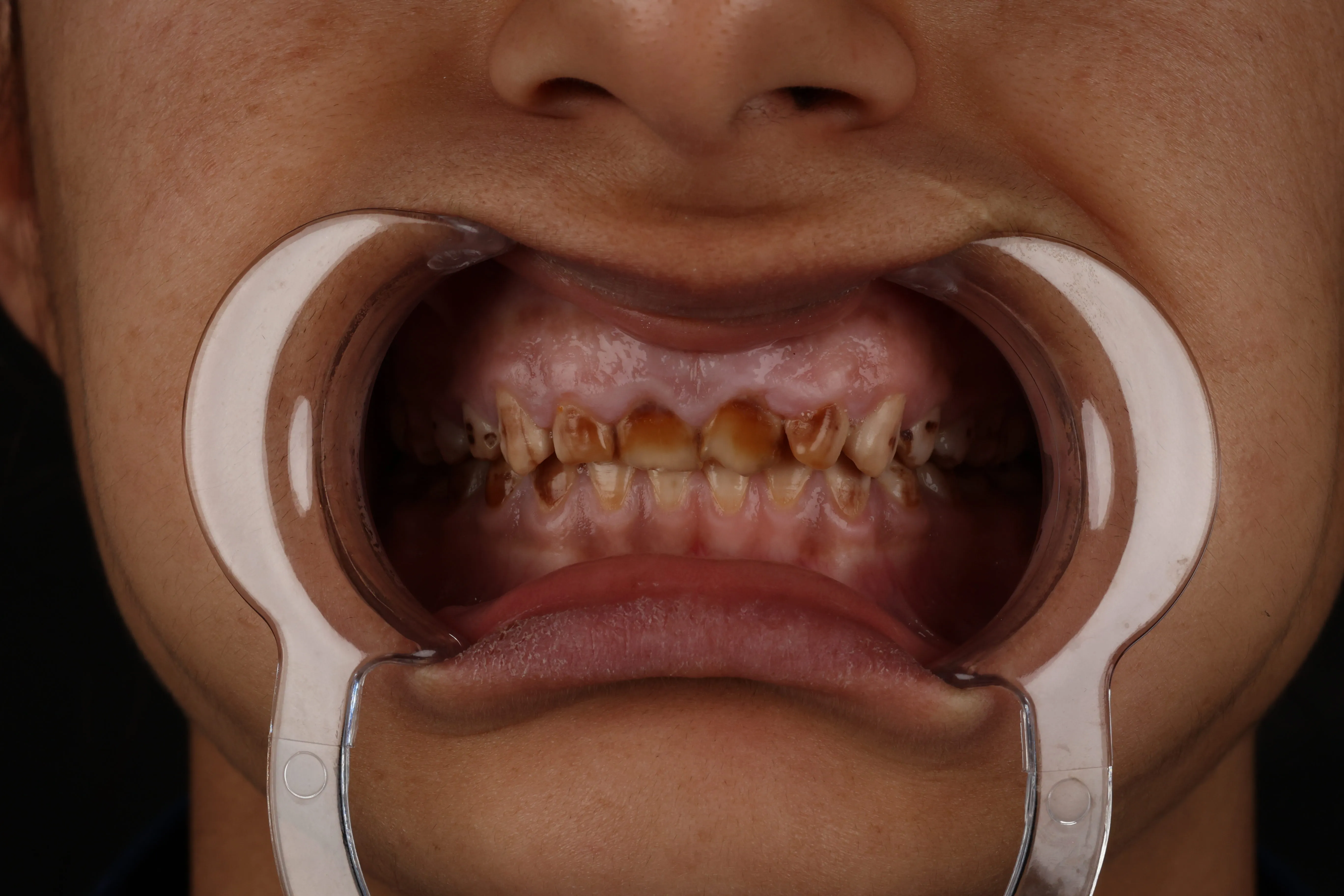 Dental treatment before and after, patient result 3 — Before